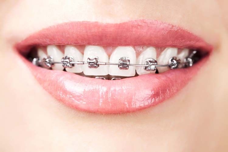 sonrisa con ortodoncia